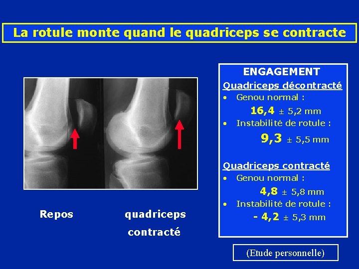 La rotule monte quand le quadriceps se contracte ENGAGEMENT Quadriceps décontracté • Genou normal