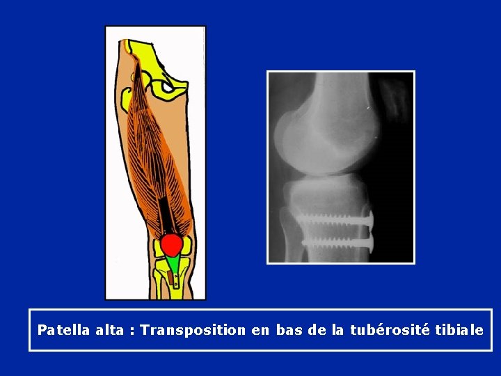 Patella alta : Transposition en bas de la tubérosité tibiale 