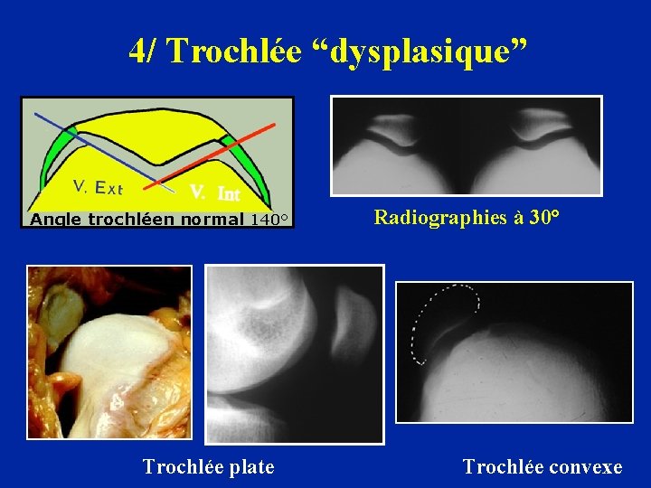 4/ Trochlée “dysplasique” Angle trochléen normal 140° Trochlée plate Radiographies à 30° Trochlée convexe