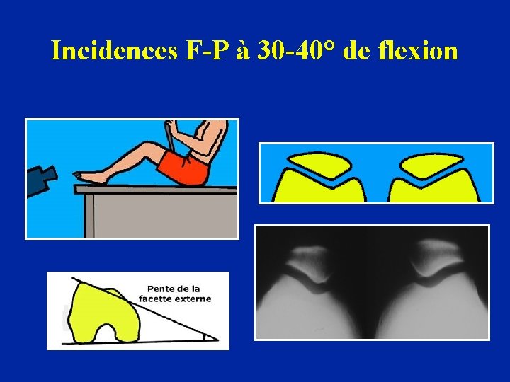 Incidences F-P à 30 -40° de flexion 