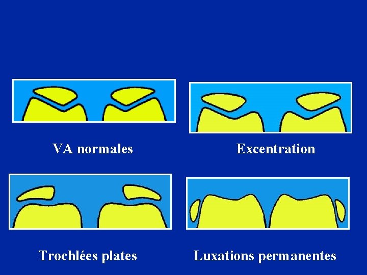 VA normales Trochlées plates Excentration Luxations permanentes 