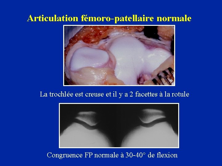 Articulation fémoro-patellaire normale La trochlée est creuse et il y a 2 facettes à