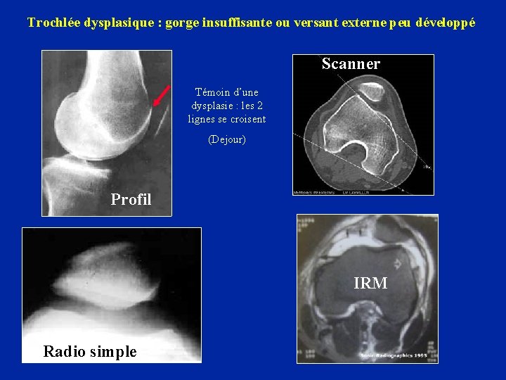 Trochlée dysplasique : gorge insuffisante ou versant externe peu développé Scanner Sc Témoin d’une