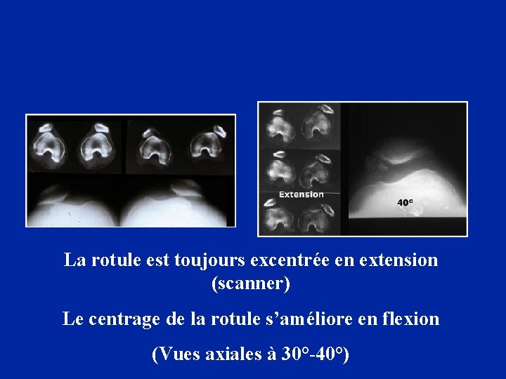 La rotule est toujours excentrée en extension (scanner) Le centrage de la rotule s’améliore