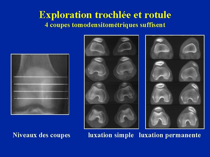 Exploration trochlée et rotule 4 coupes tomodensitométriques suffisent Niveaux des coupes luxation simple luxation