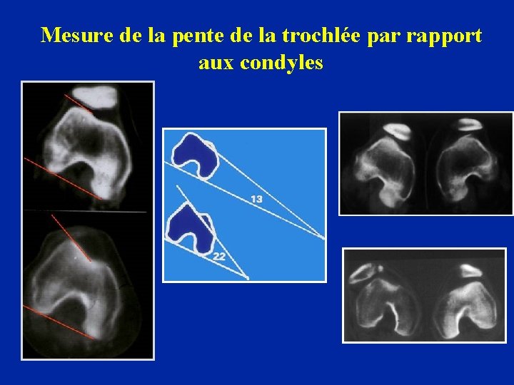 Mesure de la pente de la trochlée par rapport aux condyles 