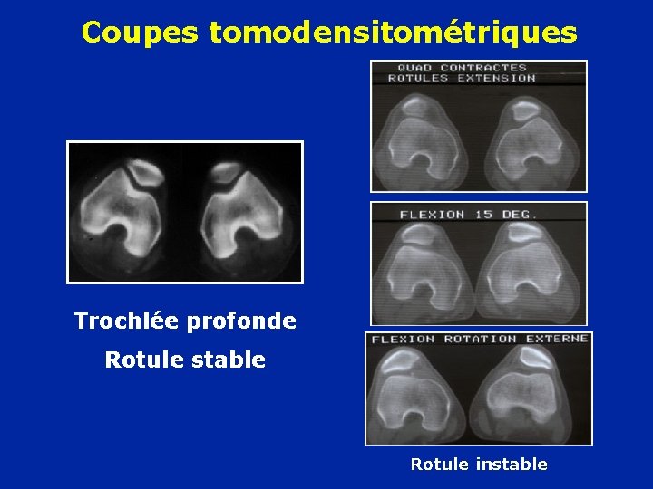 Coupes tomodensitométriques Trochlée profonde Rotule stable Rotule instable 