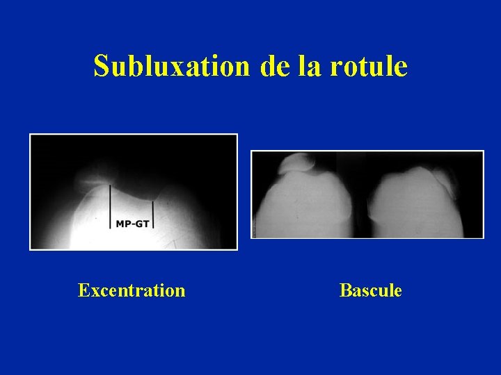 Subluxation de la rotule Excentration Bascule 