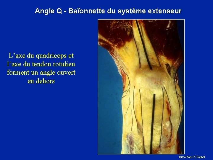 Angle Q - Baïonnette du système extenseur L’axe du quadriceps et l’axe du tendon