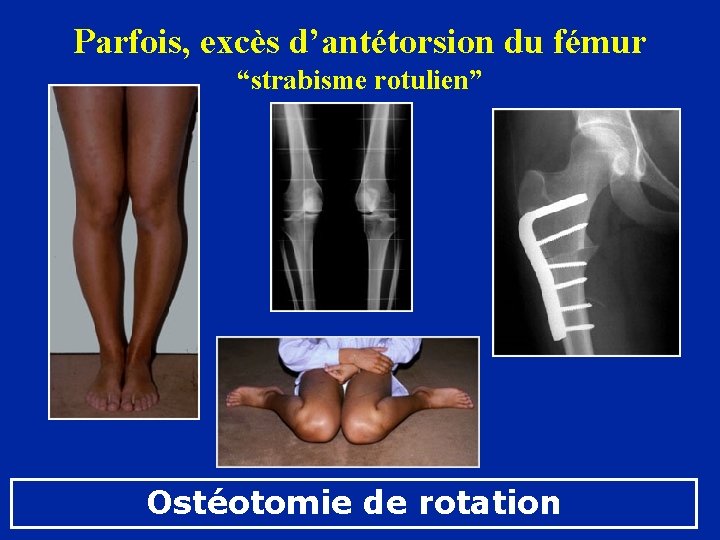 Parfois, excès d’antétorsion du fémur “strabisme rotulien” Ostéotomie de rotation 