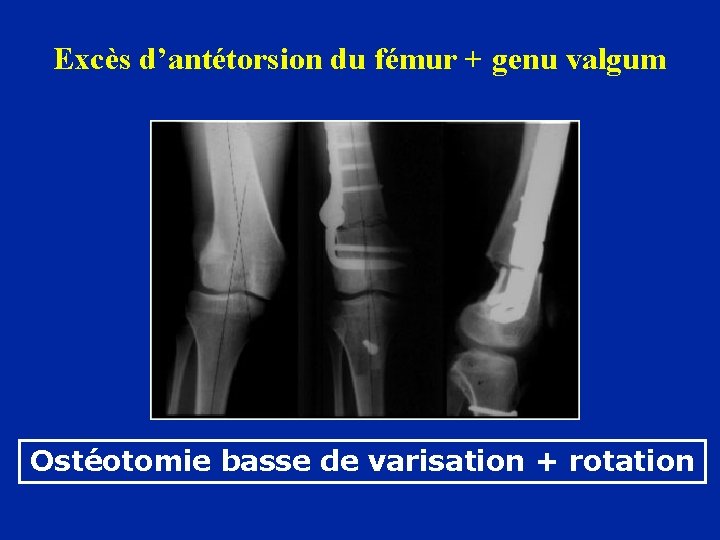 Excès d’antétorsion du fémur + genu valgum Ostéotomie basse de varisation + rotation 