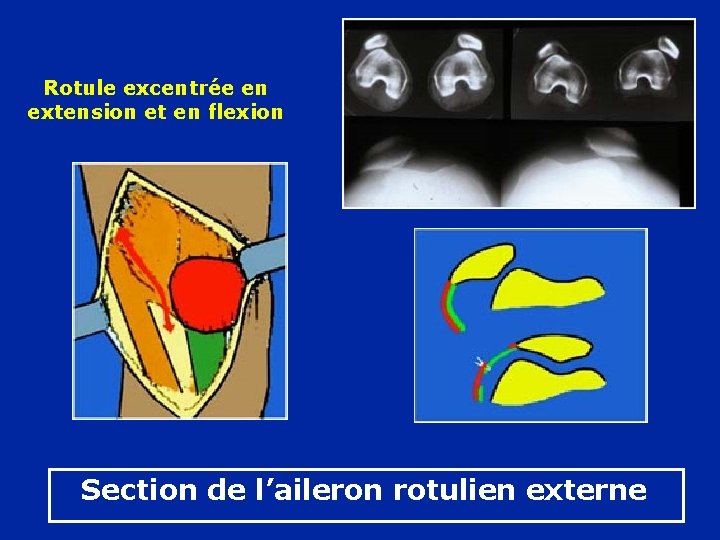 Rotule excentrée en extension et en flexion Section de l’aileron rotulien externe 