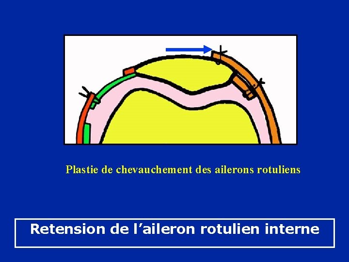 Plastie de chevauchement des ailerons rotuliens Retension de l’aileron rotulien interne 