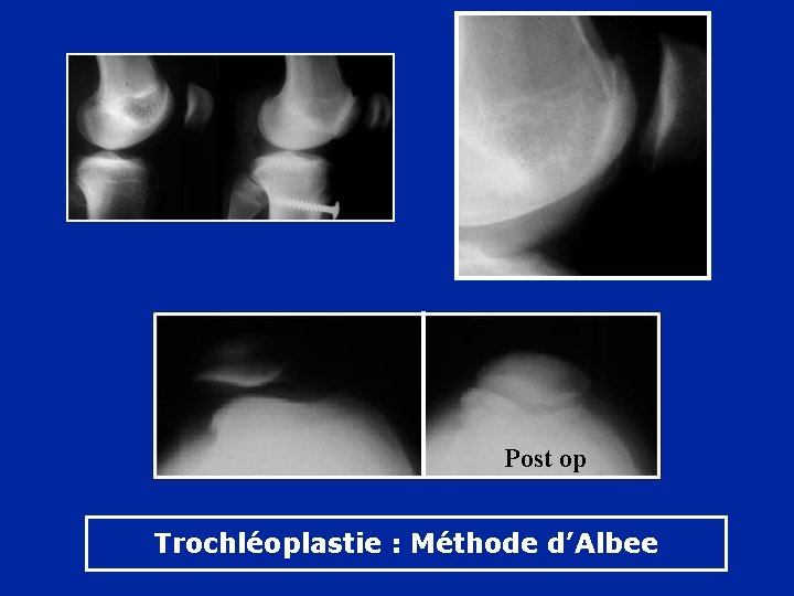 Post op Trochléoplastie : Méthode d’Albee 