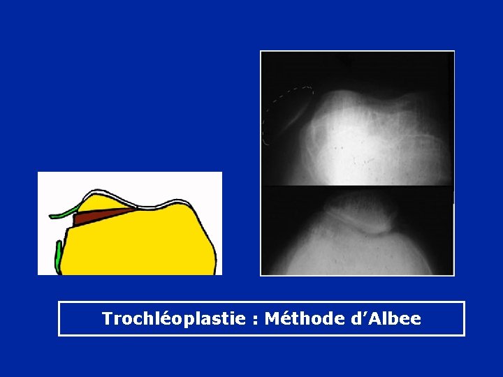 Trochléoplastie : Méthode d’Albee 