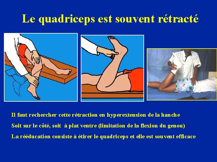 Le quadriceps est souvent rétracté Il faut recher cette rétraction en hyperextension de la