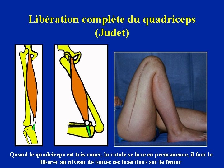 Libération complète du quadriceps (Judet) Quand le quadriceps est très court, la rotule se