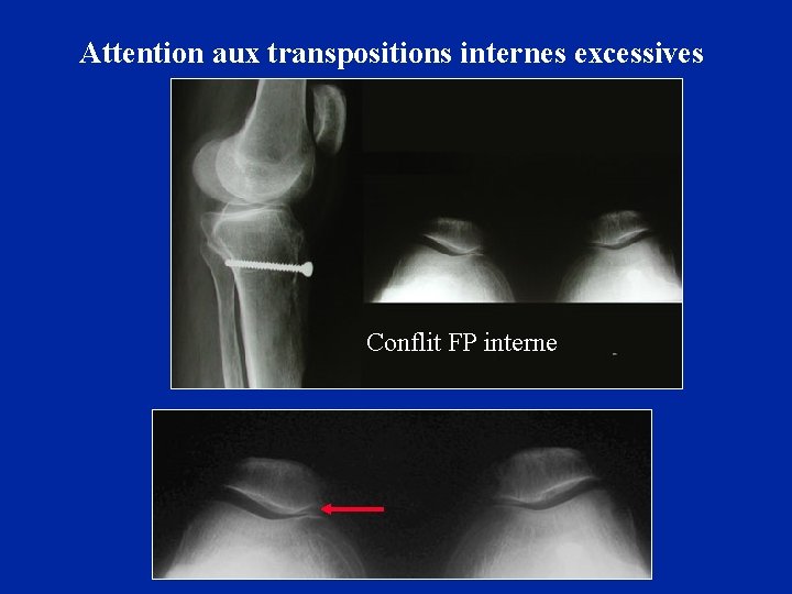 Attention aux transpositions internes excessives Conflit FP interne 