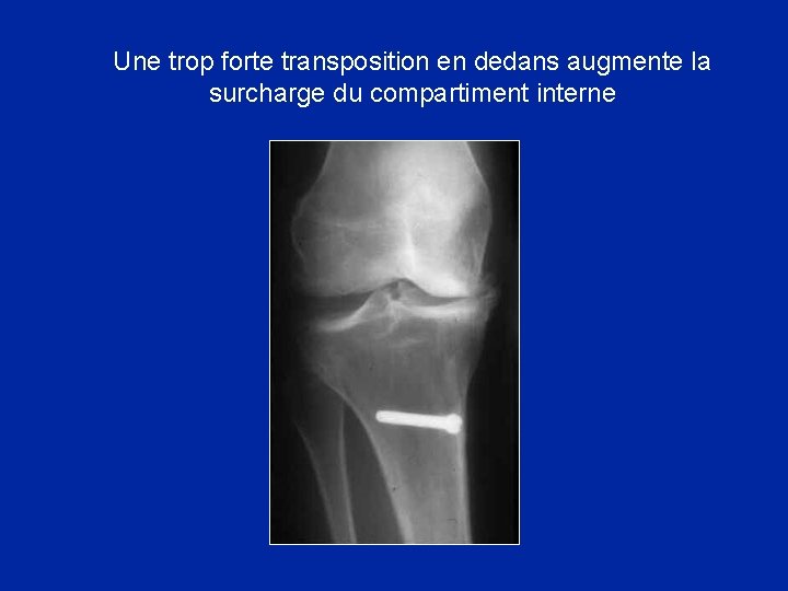 Une trop forte transposition en dedans augmente la surcharge du compartiment interne 