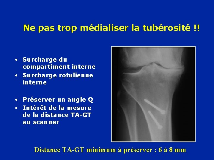 Ne pas trop médialiser la tubérosité !! • Surcharge du compartiment interne • Surcharge