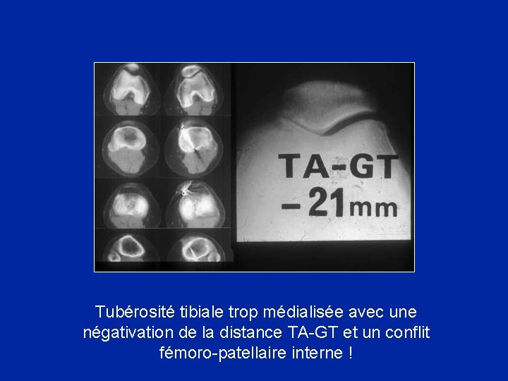 Tubérosité tibiale trop médialisée avec une négativation de la distance TA-GT et un conflit