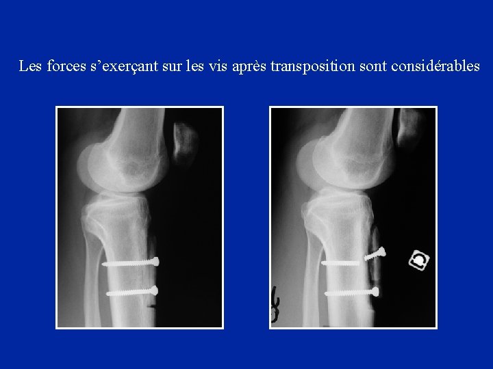 Les forces s’exerçant sur les vis après transposition sont considérables 