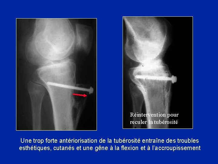 Réintervention pour reculer la tubérosité Une trop forte antériorisation de la tubérosité entraîne des