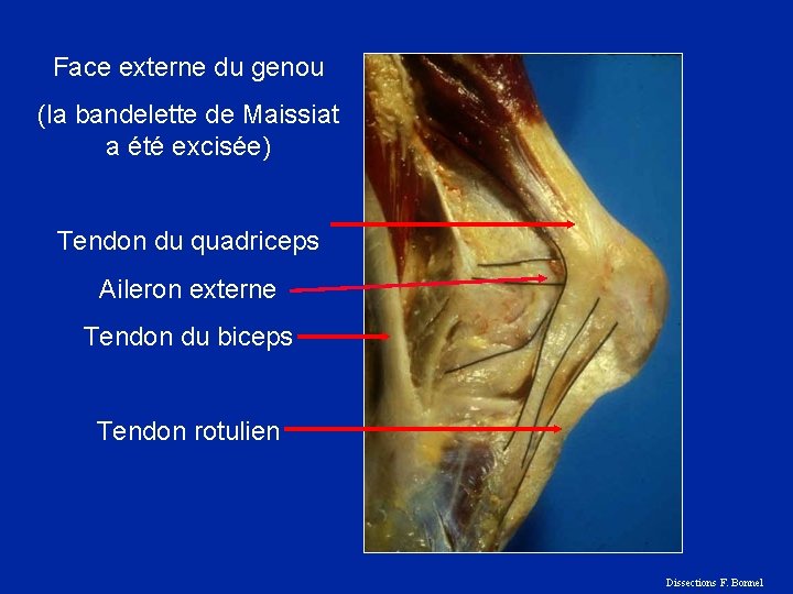 Face externe du genou (la bandelette de Maissiat a été excisée) Tendon du quadriceps
