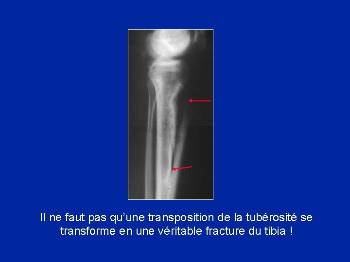 Il ne faut pas qu’une transposition de la tubérosité se transforme en une véritable