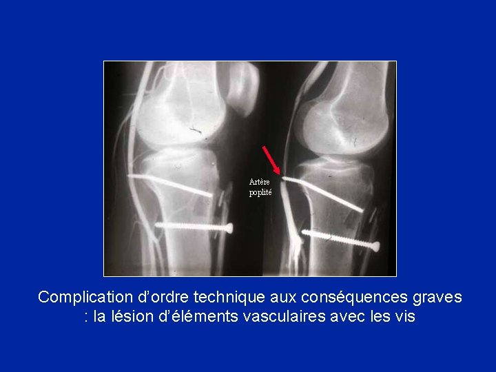 Artère poplité Complication d’ordre technique aux conséquences graves : la lésion d’éléments vasculaires avec