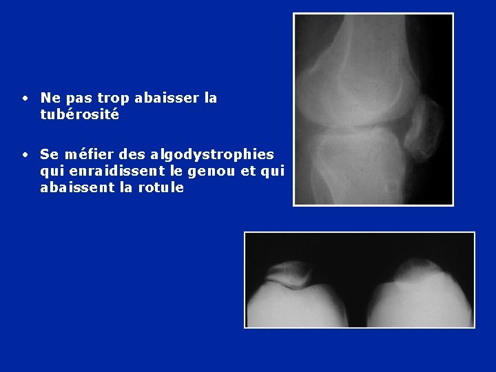  • Ne pas trop abaisser la tubérosité • Se méfier des algodystrophies qui