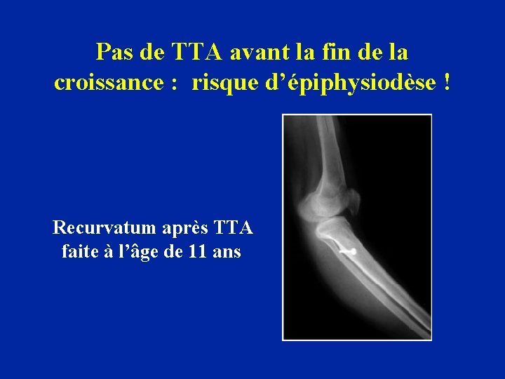 Pas de TTA avant la fin de la croissance : risque d’épiphysiodèse ! Recurvatum