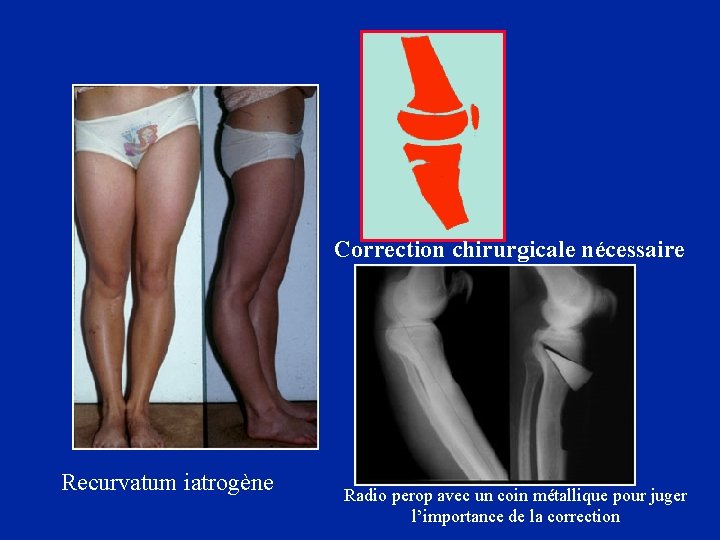 Correction chirurgicale nécessaire Recurvatum iatrogène Radio perop avec un coin métallique pour juger l’importance