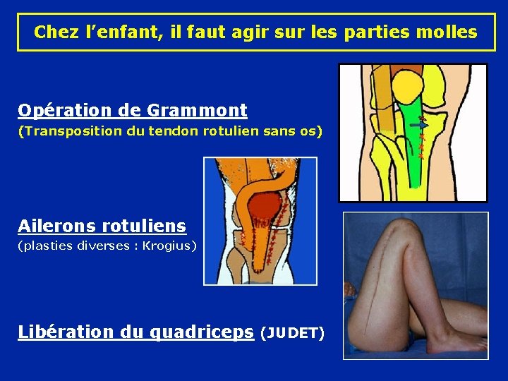 Chez l’enfant, il faut agir sur les parties molles Opération de Grammont (Transposition du