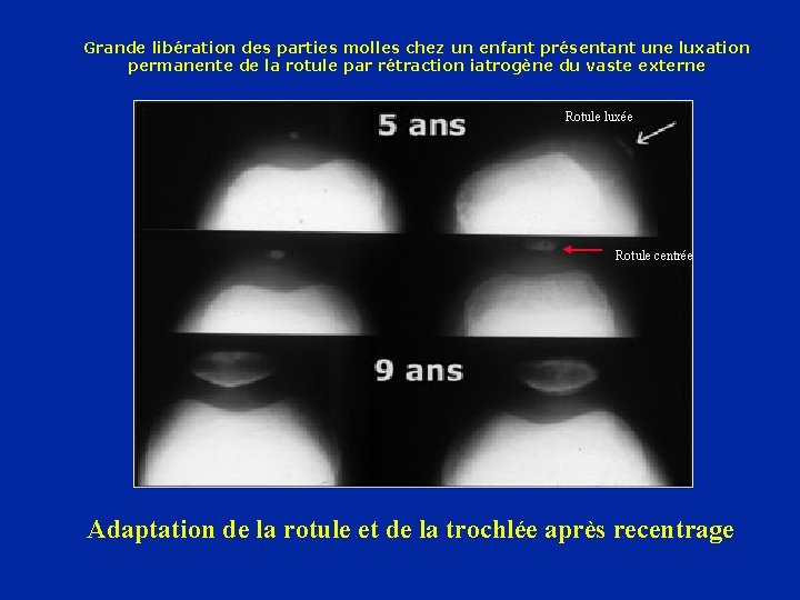 Grande libération des parties molles chez un enfant présentant une luxation permanente de la