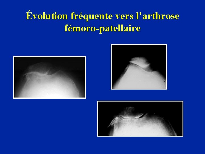 Évolution fréquente vers l’arthrose fémoro-patellaire 