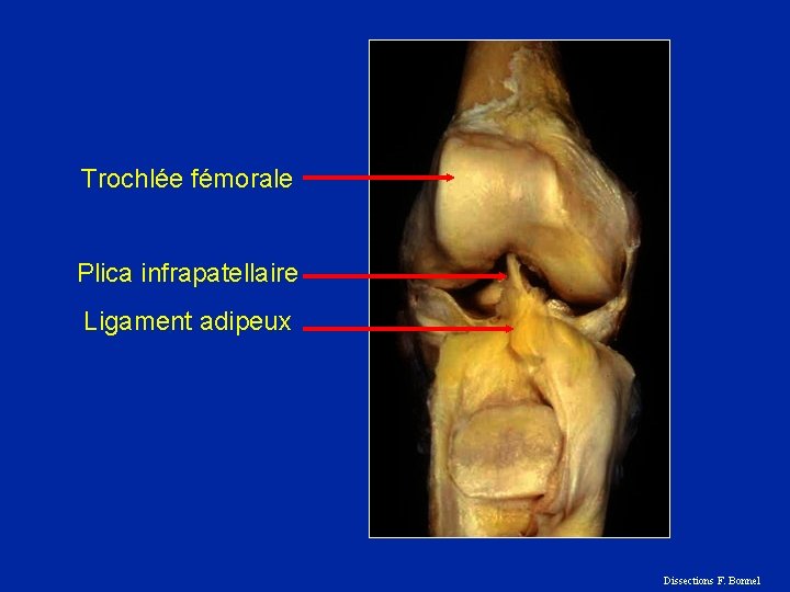 Trochlée fémorale Plica infrapatellaire Ligament adipeux Dissections F. Bonnel 