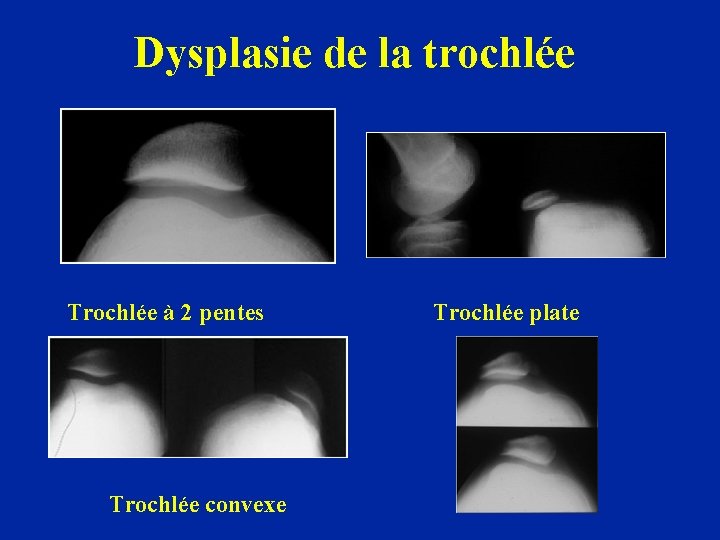 Dysplasie de la trochlée Trochlée à 2 pentes Trochlée convexe Trochlée plate 