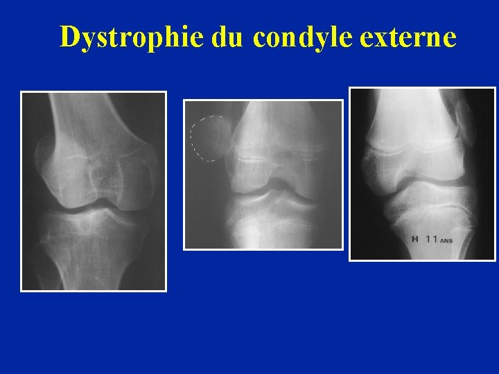 Dystrophie du condyle externe 