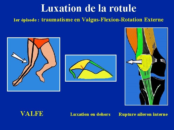 Luxation de la rotule 1 er épisode : traumatisme en Valgus-Flexion-Rotation Externe VALFE Luxation