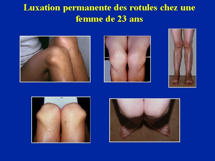 Luxation permanente des rotules chez une femme de 23 ans 