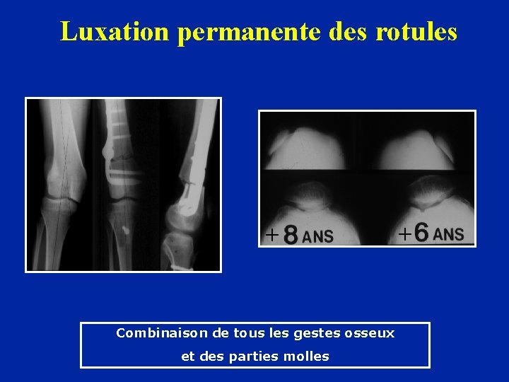 Luxation permanente des rotules + + Combinaison de tous les gestes osseux et des