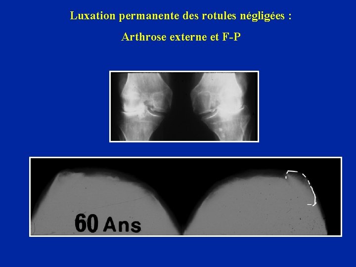 Luxation permanente des rotules négligées : Arthrose externe et F-P 