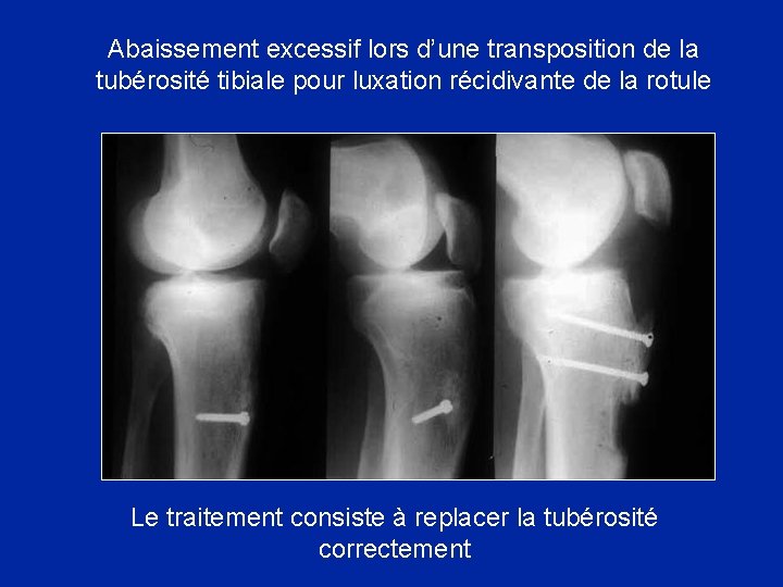 Abaissement excessif lors d’une transposition de la tubérosité tibiale pour luxation récidivante de la