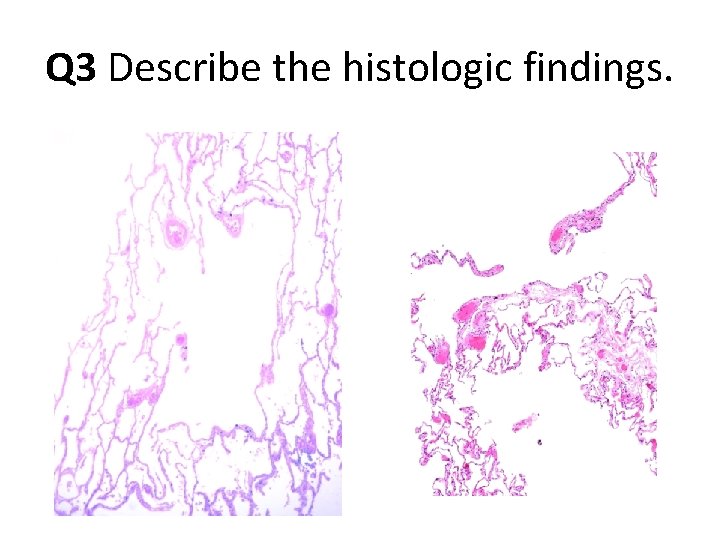 Q 3 Describe the histologic findings. Q 3 Describe the histologic findings.