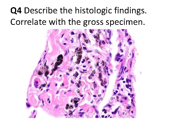 Q 4 Describe the histologic findings. Correlate with the gross specimen. Q 4 Describe the histologic findings. Correlate with the gross specimen.