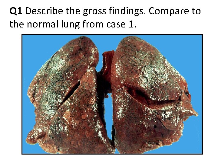 Q 1 Describe the gross findings. Compare to the normal lung from case 1. Q 1 Describe the gross findings. Compare to the normal lung from case 1.