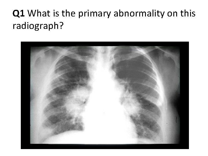 Q 1 What is the primary abnormality on this radiograph? Q 1 What is the primary abnormality on this radiograph?