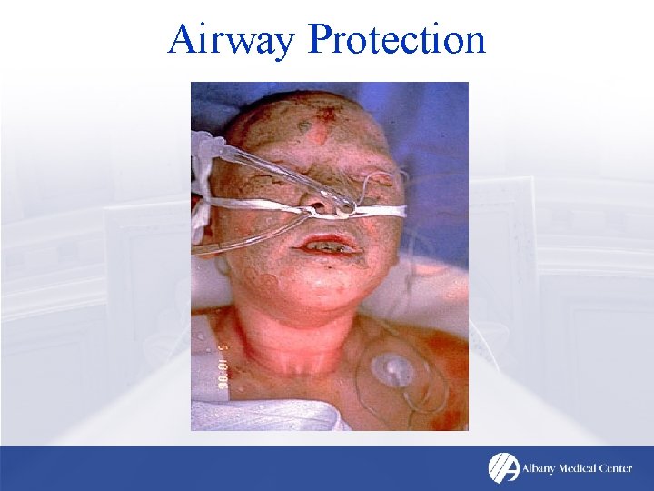 Airway Protection 