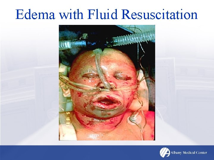 Edema with Fluid Resuscitation 